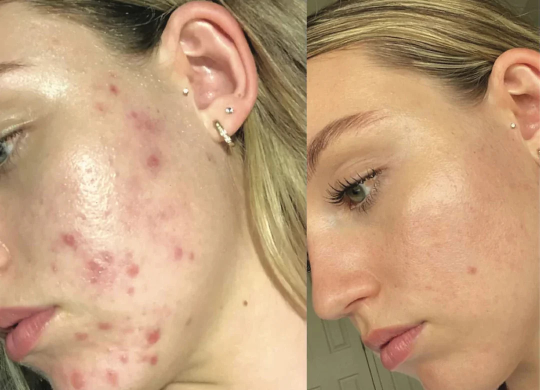 Acne Myths