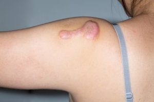 Secrets of Keloid Scars