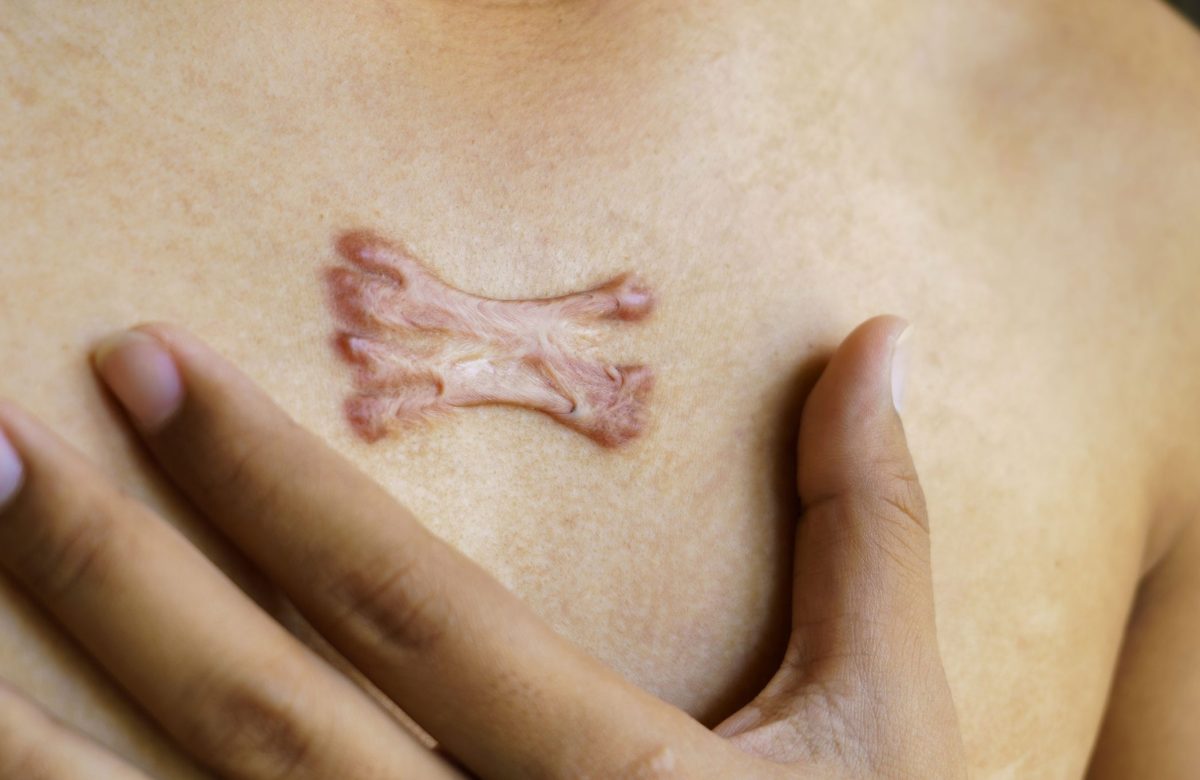Secrets of Keloid Scars