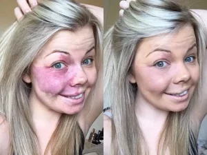 World of Port-Wine Stains