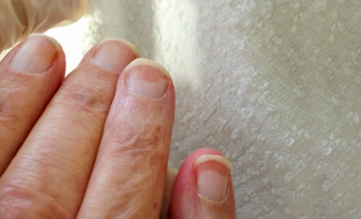 Fingernail Changes