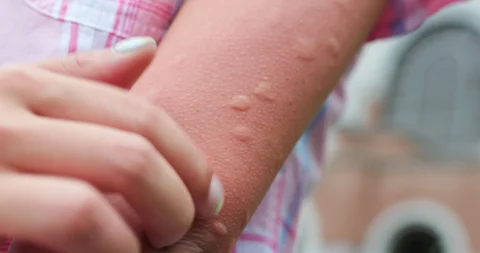 Mosquito Bites