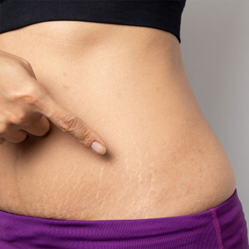 Story of Stretch Marks