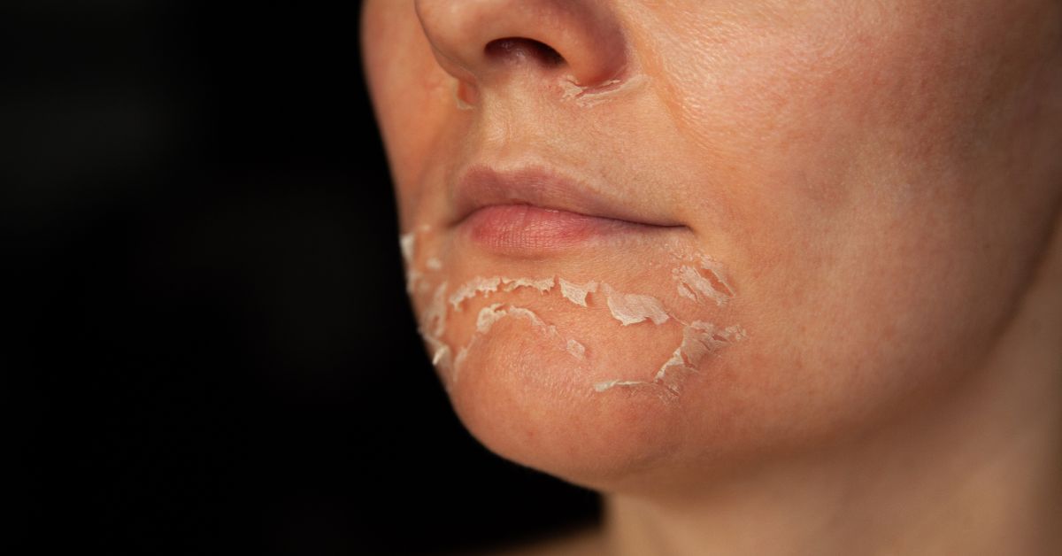 Dry Peeling Skin